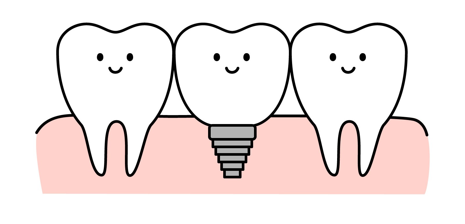 インプラントイラスト