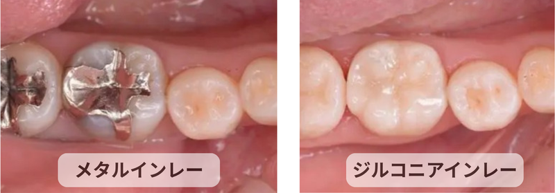 メタルとジルコニアインレー