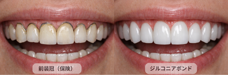 ジルコニアボンド