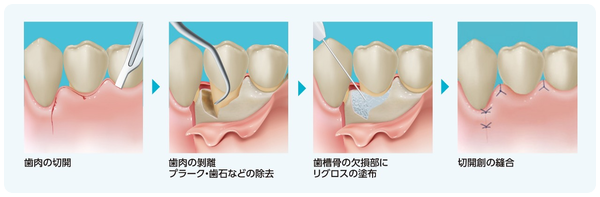 s_b8c08f9fcdec435f9a84524953b569e4 (手術の流れ)