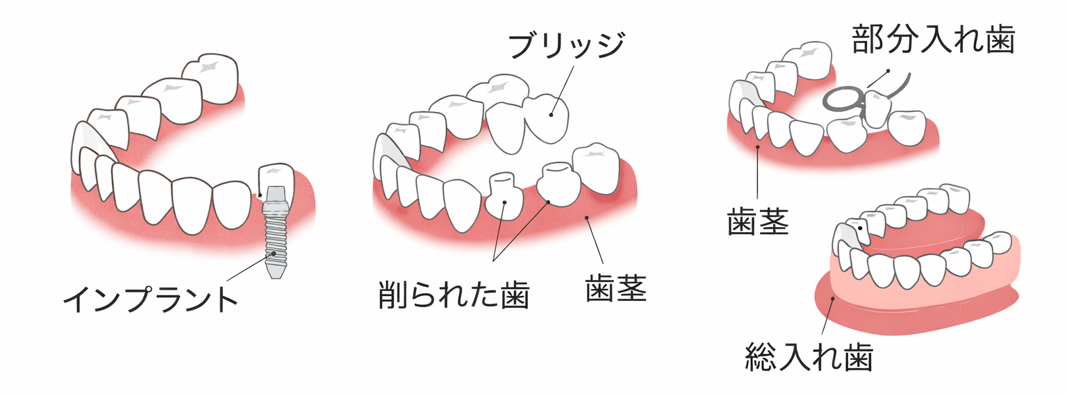 インプラントブリッジ義歯