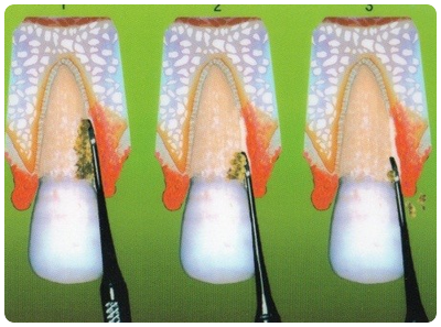 スケーリング・ルートプレーニング